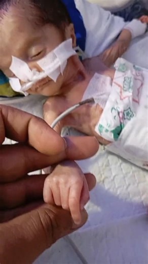 My Preemie 20 Weeks Baby Life Journey😢 #prematurebaby #baby #newbornbaby #preemiebaby #20weeksbaby