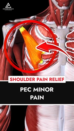 Dr. Joey Seyforth PT, DPT, ATC, CSCS on Instagram: "💥 Is Your Pec Minor Causing Shoulder Pain? 💥 ❌ If you struggle with overhead movements, your pec minor might be the hidden culprit. When this muscle is tight or overactive, it pulls your shoulder blade forward and down, limiting mobility and leading to pain, impingement, and poor movement mechanics. How a Tight Pec Minor Affects Your Shoulder: 🎯 Limits Overhead Mobility – A restricted shoulder blade can’t rotate properly, making overhead mov