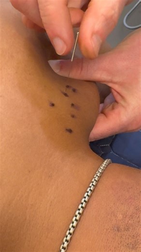 1.1M views · 1.7K reactions |  Dry needling is a treatment that...