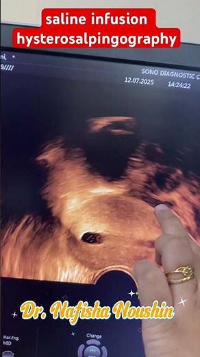 saline infusion sonography #ultrasound #salineinfusionsonography #infertility