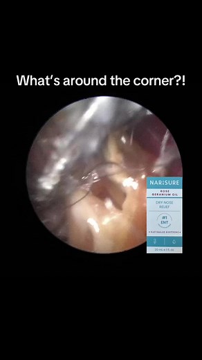 Imagine the relief of having that monster booger cleared from the sinuses! What do you think is hiding in your nose? #nose #doctor #medical #OddlySatisfying #GrossButGood @Narisure Dry Nose Relief