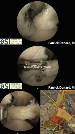 Subscapularis repair in action 🩺