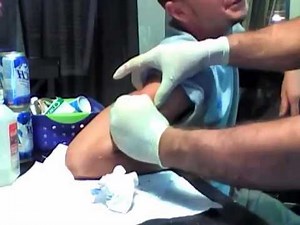 Cyst explosion AMAZING
