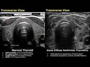 Thyroid Ultrasound Normal Vs Hashimoto Thyroiditis Imaging Findings | Acute & Chronic Stages USG