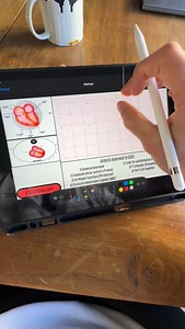 Anatomy of RBBB on ECG #ekg #ecg | ECG Lectures with Reid