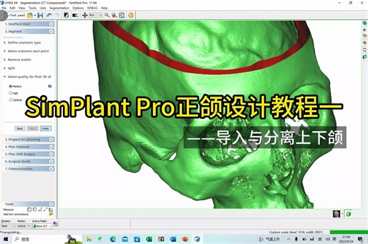 simplantpro正颌设计教程一分离上下颌