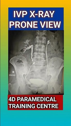 IVP X-RAY TEST | IVU | UROGRAM | UROGRAPHY | KIDNEY | URETER | STONE