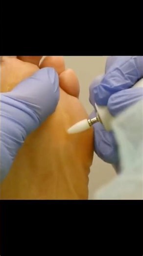 Cool Callus Foot Care