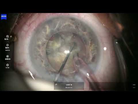 OD 2026 02 18 113156 Phaco ASX7 PEX #rare coughing during phaco, so severe phacodonesis that rhexis