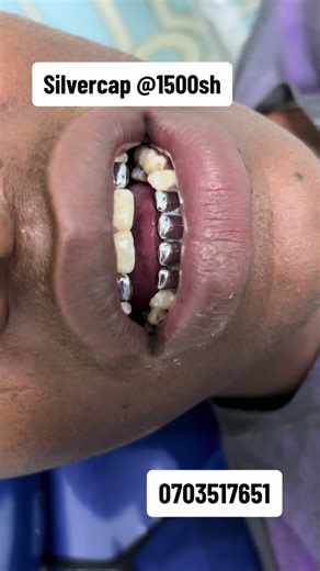 How to Put Silver Teeth at Eastlite Dental Centre