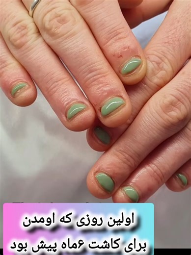 تغییرات شگفت انگیز ناخن جویده شده در ۶ ماه