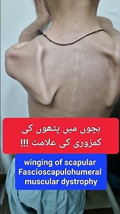 winging of scapula - Fascioscapulaohumeral muscular dystrophy- Myopathy - Muscular dystrophy -sign
