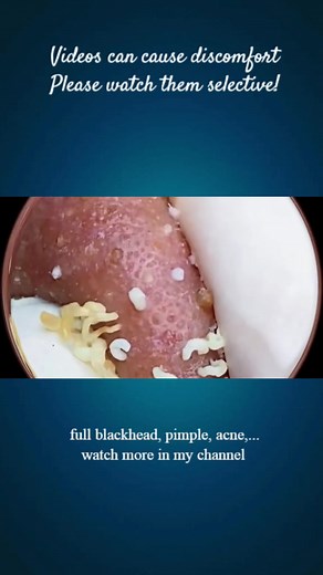 Big pimple blackhead removal #acne #pimple #blackhead #extractions #satisfying