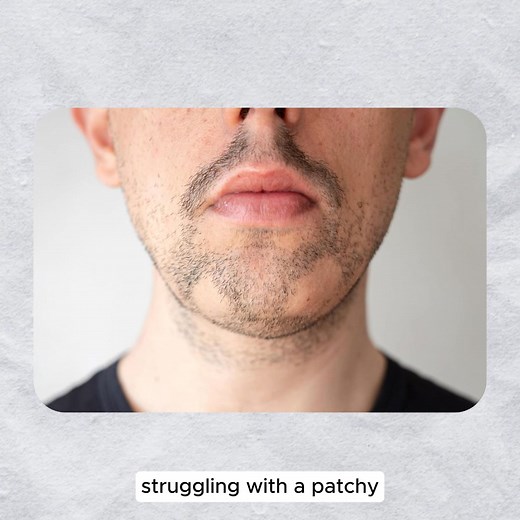 Want a fuller, thicker beard before the year ends? Click "Read More" to find out how! 👉 Struggling with patchy growth or thin spots? You’re not alone — and it’s fixable. The Odenson Beard Growth Serum is scientifically developed to awaken dormant follicles and trigger new growth in just weeks. 💥 Powered by Capilia Longa, a breakthrough turmeric stem cell extract that stimulates growth right at the root — helping you achieve a thicker, more defined beard faster. Pair it with the Beard Roller to