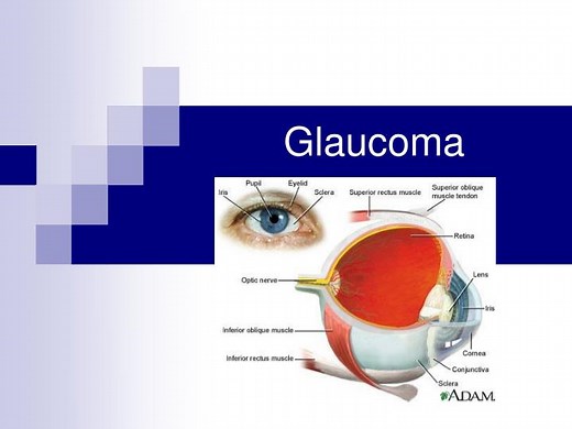 Glaucoma - SlideServe