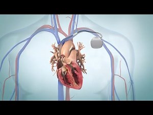 Artificial cardiac pacemaker
