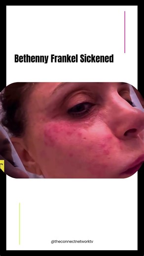 Frankel Blames Hotel