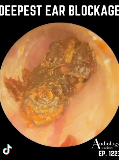 Challenging Ear Wax Removal Process Explained