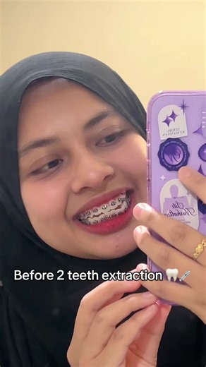 Braces Journey: Before and After Teeth Extraction