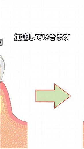 【1週間・1ヵ月・半年？】虫歯進行速度を具体的に解説！CO〜C3の進み方 #虫歯進行速度 #虫歯