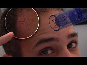 Microneedling My Scalp for Hair Loss with the Dr Pen A6 - My 10-Day Routine