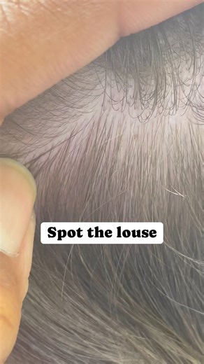 Spot the louse l louse is singular and lice in plural… in this video there is 1 louse l lice removal service #momlife #lice #hair #school #explore | Stacey The Louse Lady