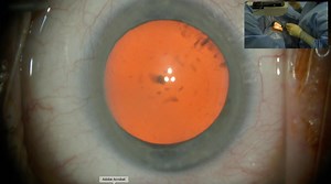 Start to Finish Phacoemulsification Procedure with Dr. Eva Liang - Eyetube