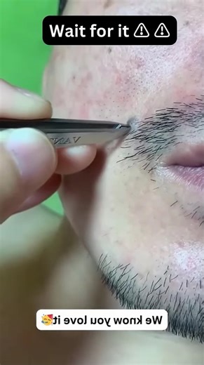 Amazing Pimple Popping Out NOW.😱😢 | Luck 18