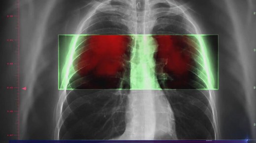 Immunotherapy transforms lung cancer, the biggest cancer killer