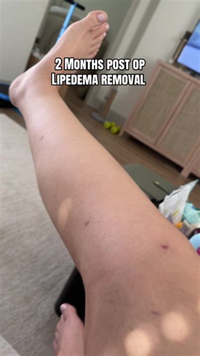 Prequel Stick for Scarring & Lipedema Recovery