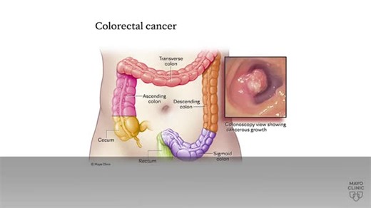 Colorectal cancer, the third-most common cancer in the U.S., has been rising among younger people for the past two decades.⁠ ⁠ Dr. Derek Ebner, a Mayo Clinic gastroenterologist, says it's important to know the warning signs of colorectal cancer and to not delay medical treatment.⁠ ⁠ Learn more: https://mayocl.in/4bD5dqX | Mayo Clinic