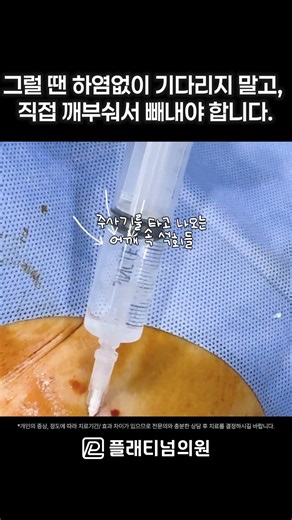 [플래티넘의원] 석회분쇄흡입술 후기, 석회성건염 어깨 통증 치료 사례