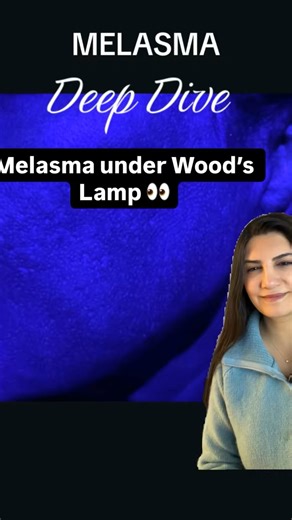 Melasma revealed: normal light vs. Wood’s lamp 🔦 Pigment depth matters! | Dermatology Solutions, Sanober Amin MD PhD