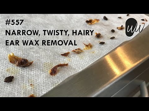 557 - Narrow, Twisty, Hairy Ear Wax Removal