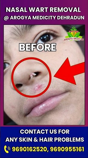 Wart Removal by Agnikarma #skincare #skincareroutine #skincaretips