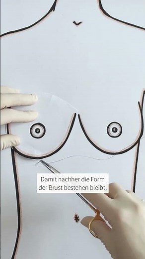 Mastektomie & Wiederaufbau bei Brustkrebs: Was ist möglich? | clinic utoquai