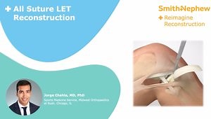 All-Suture Modified Lemaire Extra-Articular Tenodesis (LET)