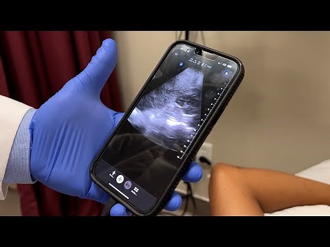 What is Butterfly iQ Ultrasound?