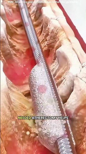 Atherectomy procedure to clear blocked arteries 3D animation #drone #theflash #space #voluson