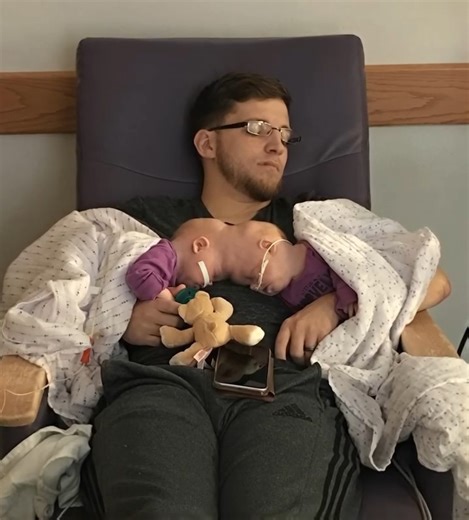 30K views · 120 reactions | These Siamese sisters were born with...