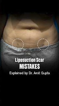 Visible Liposuction Scars? | How Proper Incision Placement Makes a Difference