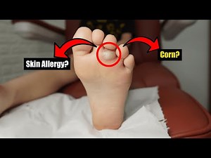 Infected Corn or Allergic Reaction?