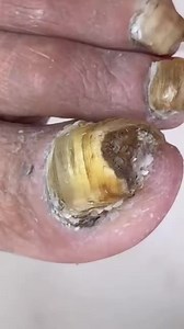 This toenail moment shocked even professionals UCNC Beautiful moments of care and relaxation through a gentle pedicure experience. Simple, clean, and satisfying. 🌿✨ Disclaimer: This video is for educational and relaxation purposes only. All content belongs to the respective owners, no copyright infringement is intended. | Care ASMR