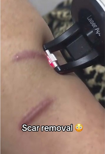Scar Removal Techniques: Discover Effective Treatments