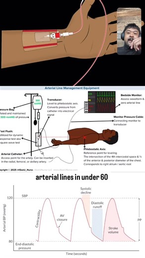 Carl Dela Cruz on Instagram: "🎙️ Arterial Line — 60-Second Breakdown The arterial line is your most accurate, real-time blood pressure monitor in anesthesia. A small catheter sits in an artery — usually the radial — and arterial pressure travels through fluid-filled tubing to a transducer, which converts that pressure into an electrical signal. That’s how you get beat-to-beat BP and a continuous arterial waveform. The waveform tells you key physiology: • Systolic peak → ventricular contraction 