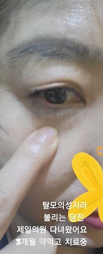 탈모약 머리카락이 숭숭 자라고 있어요# 탈모치료중 대박#진짜머리카락이 자람#당진제일의원다녀요