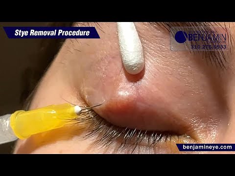 Stye Treatment: Real Procedure, Real Laughs at Benjamin Eye Institute