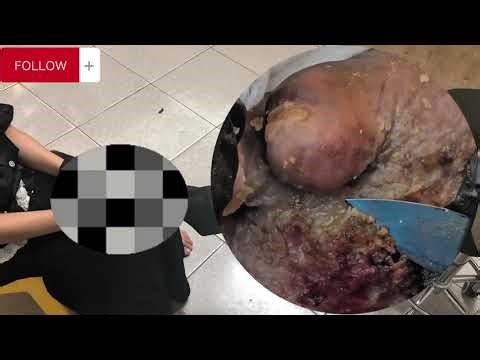 🤯 Jigger Infestation Horror – Skin Full of Parasites #AF279