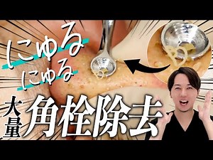 【スッキリ】巨大な角栓を圧出！にゅるにゅるしてる正体を解説します！【角栓除去/ブラックヘッド/ニキビ/いちご鼻】／Blackhead Removal Show