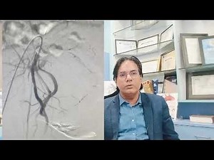 "Uterine Artery Embolization ( UAE) for Fibroids🌟A Non -Surgical💖 Solution Explained- Expert Guide"